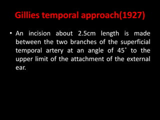 Gillies temporal approach(1927)
• An incision about 2.5cm length is made
between the two branches of the superficial
temporal artery at an angle of 45˚ to the
upper limit of the attachment of the external
ear.
 