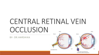 CENTRAL RETINAL VEIN
OCCLUSION
BY- DR.HARSHIKA
 